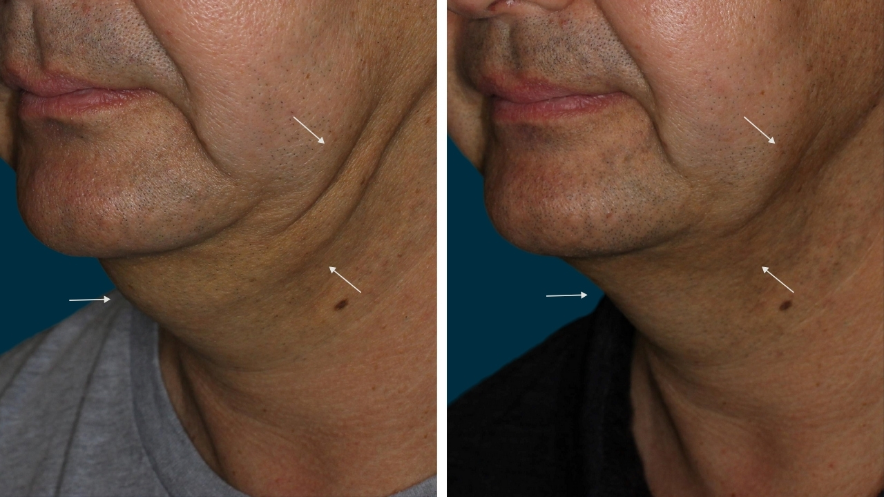 Coolsculpting - Submental (Under Chin)
