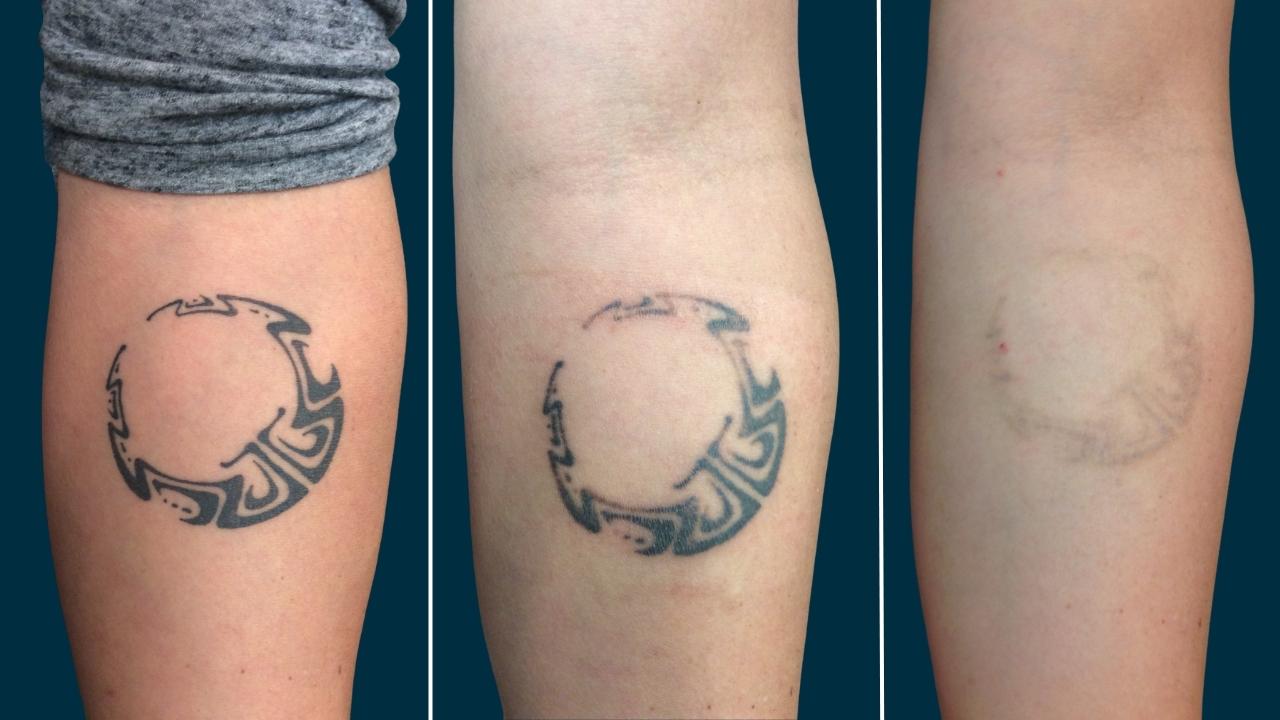 Transitions of Tattoo Removal