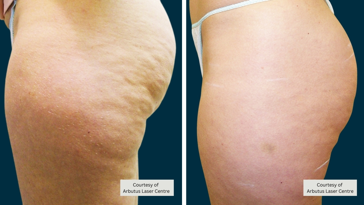 Coolsculpting Before And After - Shaping My Waist - Whistler Medical  Aesthetics