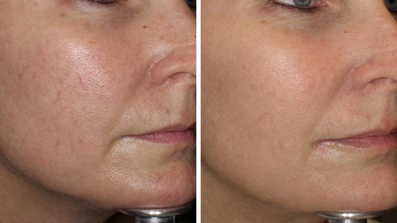 Sun Damage and Diffuse Redness