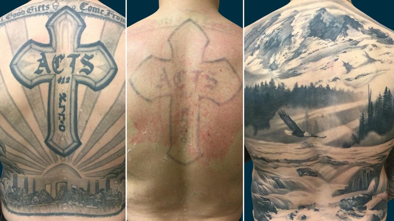 Tattoo Removal & Cover Up