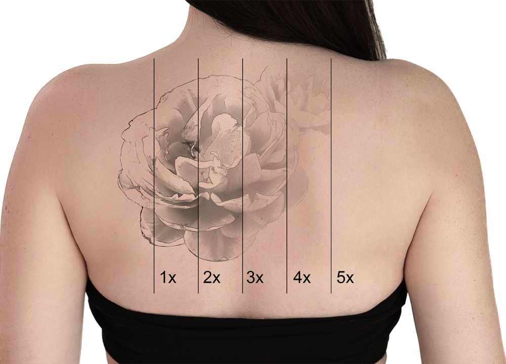 Tattoo Removal — Advanced Laser Aesthetics