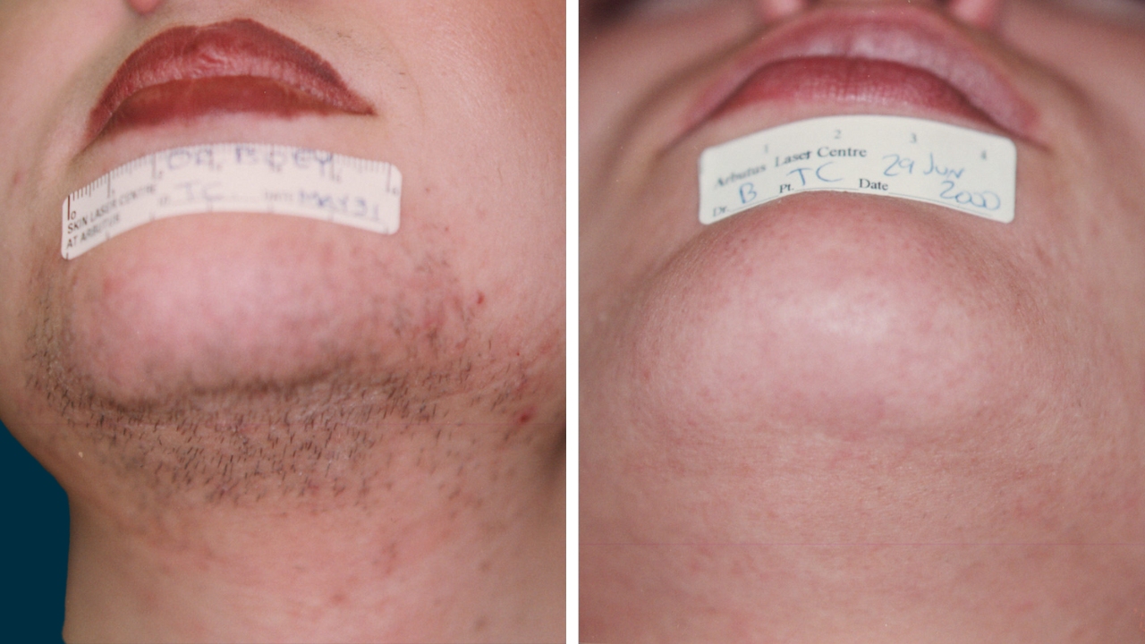 Laser Hair Removal - Face (After 5 Treatments)