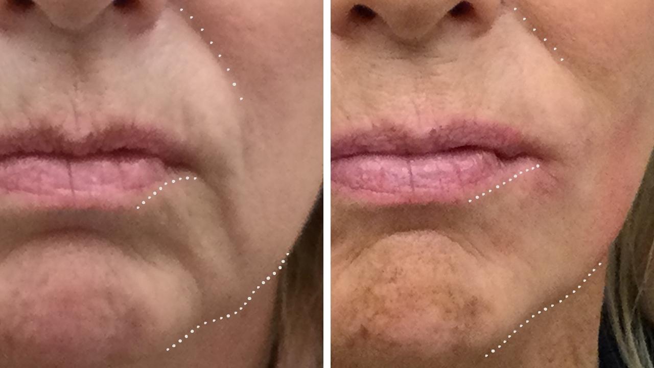 Nasal Labial Folds (Smile Lines), Marionette Lines & Jowl Lifting