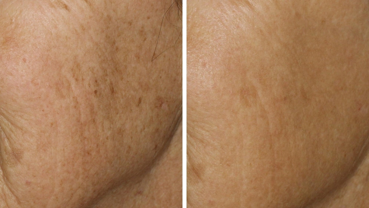 Pigmentation Skin Resurfacing (After 1 Treatment)