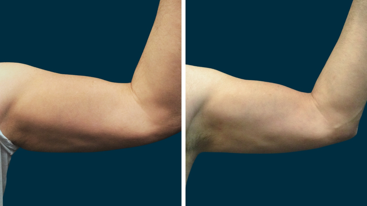 Inner Upper Arms Skin Laxity