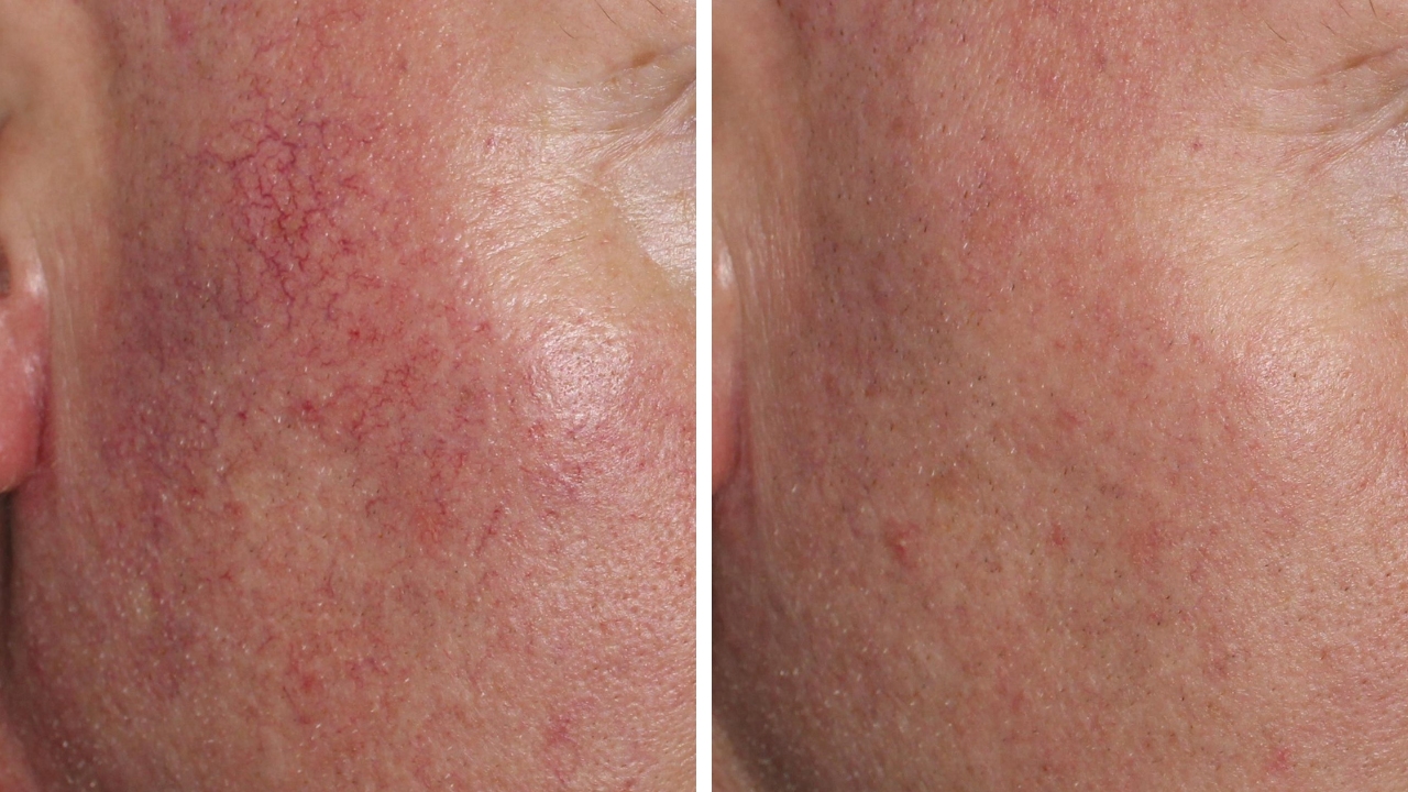 Spider Veins and Facial Redness