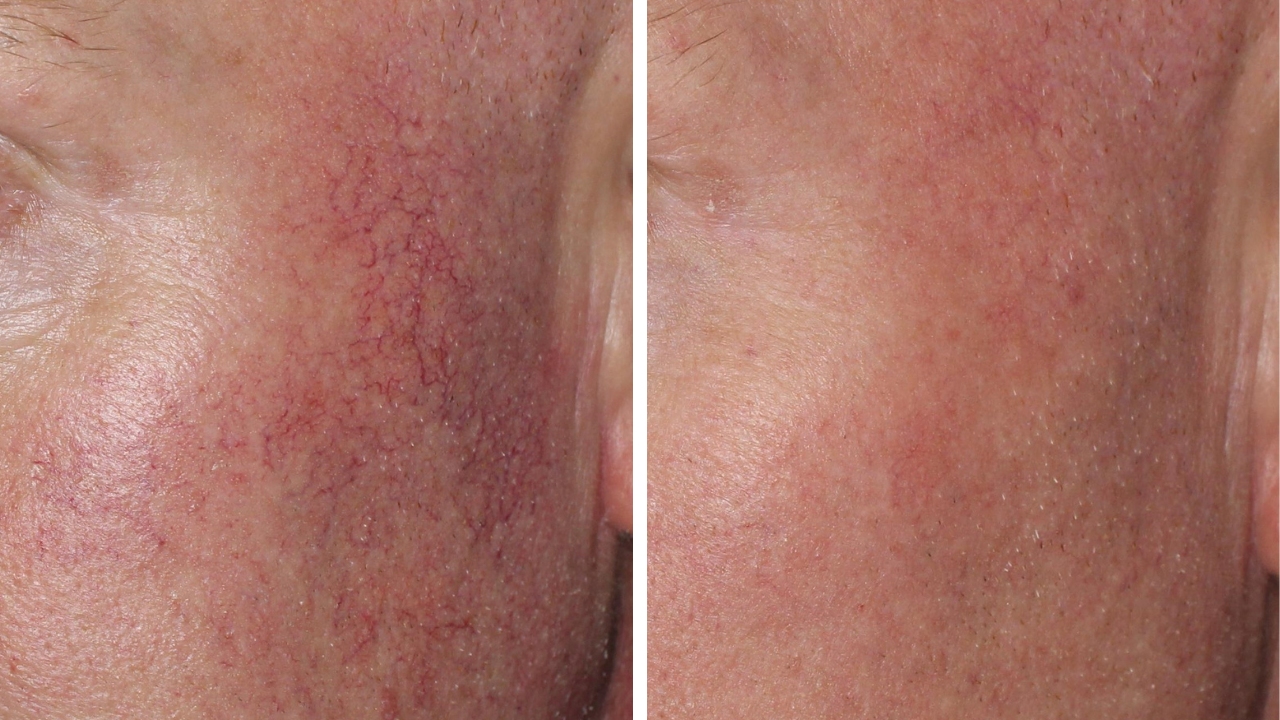 Spider Veins and Facial Redness